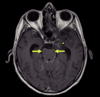 Figure 2: Glioblastoma