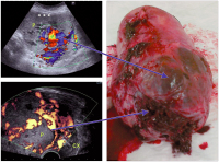 Abbildung 2: Placenta praevia percreta