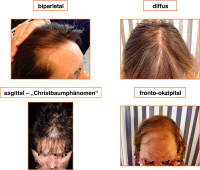 Abbildung 3: Alopecia androgenetica