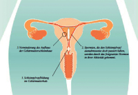 Abbildung 1: Mirena(R)