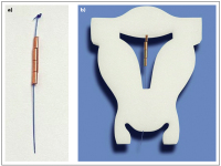 Abbildung 1: Gynefix(R)
