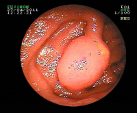 Abbildung 3: Peutz-Jeghers-Polyp