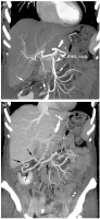 Abbildung 2a-b: MDCT - Jejunumschlinge