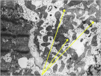 Abbildung 2: Endomyokardbiopsie