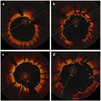 Abbildung 1a-d: Stent-Struts
