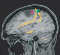 Figure 1: Glioma - Surgery