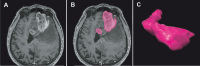 Figure 2a-c: Glioma - Surgery
