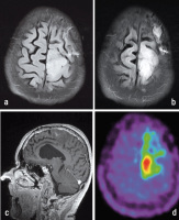 Figure 1-d: Tumour