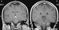 Figure 1a-b: Brain MRI