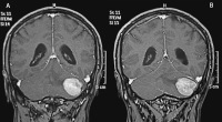 Figure 2a-b: Brain MRI