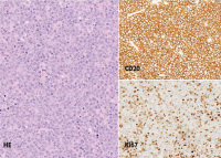 Figure 3: B-cell Lymphoma