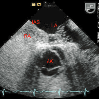Abbildung 1: Offenes Foramen ovale