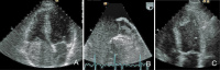 Abbildung 12a-c: Vorhofmyxom - Thrombus