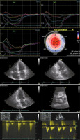 Abbildung 13: Low-flow-Aortenstenose