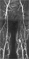 Abbildung 1: Arteria femoralis superficialis