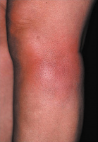 Abbildung 1: Erythema nodosum