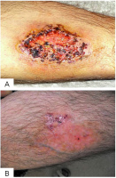 Abbildung 2a-b: Pyoderma gangraenosum