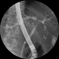Abbildung 3: Cholangitis