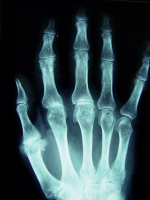 Abbildung 1: Arthropathie