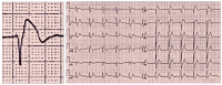 Abbildung 1: Brugada-Syndrom