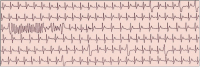 Abbildung 2: Brugada-Syndrom