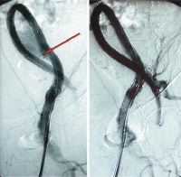 Abbildung 3a-b: Iliaca-Aneurysma