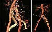 Abbildung 4: Iliaca-Aneurysma