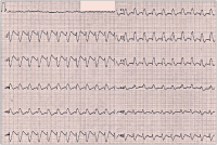 Abbildung 1: EKG