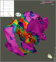 Abbildung 2: Elektroanatomisches Mapping
