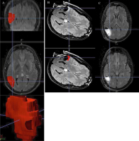 Figure 1a-c: Seizures
