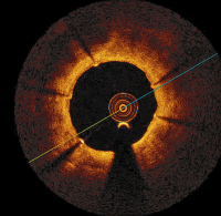 Abbildung 5: Aneurysma
