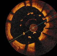 Abbildung 6: Aneurysma