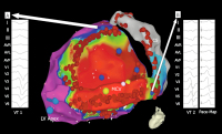 Abbildung 1A-B: Catheter Ablation