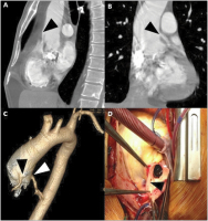 Abbildung 1A-D: Coronary artery