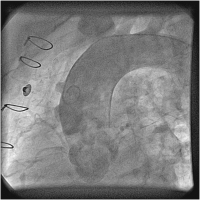 Abbildung 1: Catheter-Induced Dissection