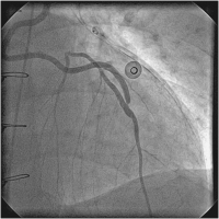 Abbildung 2: Catheter-Induced Dissection