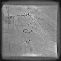 Abbildung 3: Catheter-Induced Dissection