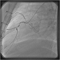 Abbildung 4: Catheter-Induced Dissection