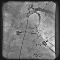 Abbildung 6: Catheter-Induced Dissection