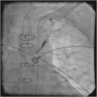 Abbildung 7: Catheter-Induced Dissection