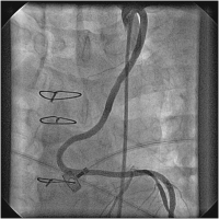 Abbildung 8: Catheter-Induced Dissection