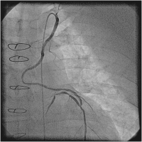 Abbildung 9: Catheter-Induced Dissection