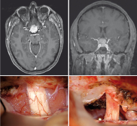 Figure 1: Intracranial Meningioma