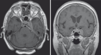 Figure 2: Intracranial Meningioma