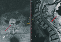 Figure 2: Spinal Menigioma