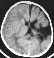 Figure 1: Brain-Collision-Tumour