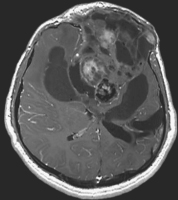 Figure 2: Brain-Collision-Tumour