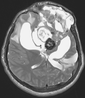 Figure 3: Brain-Collision-Tumour