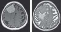 Figure 1: Meningeoma