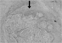 Figure 2: Nerve-Infiltration